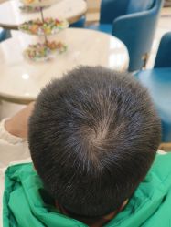 -碧莲盛·不剃发植发