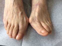 -德哥灰指甲脚气甲沟炎跖疣护理