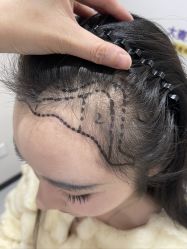 -大麦微针植发全国连锁