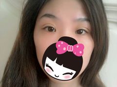 10天后的照片，左眼比右眼肿一点-上海华安整形外科门诊部