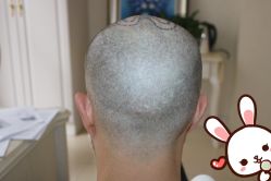 -大麦微针植发丨全国连锁