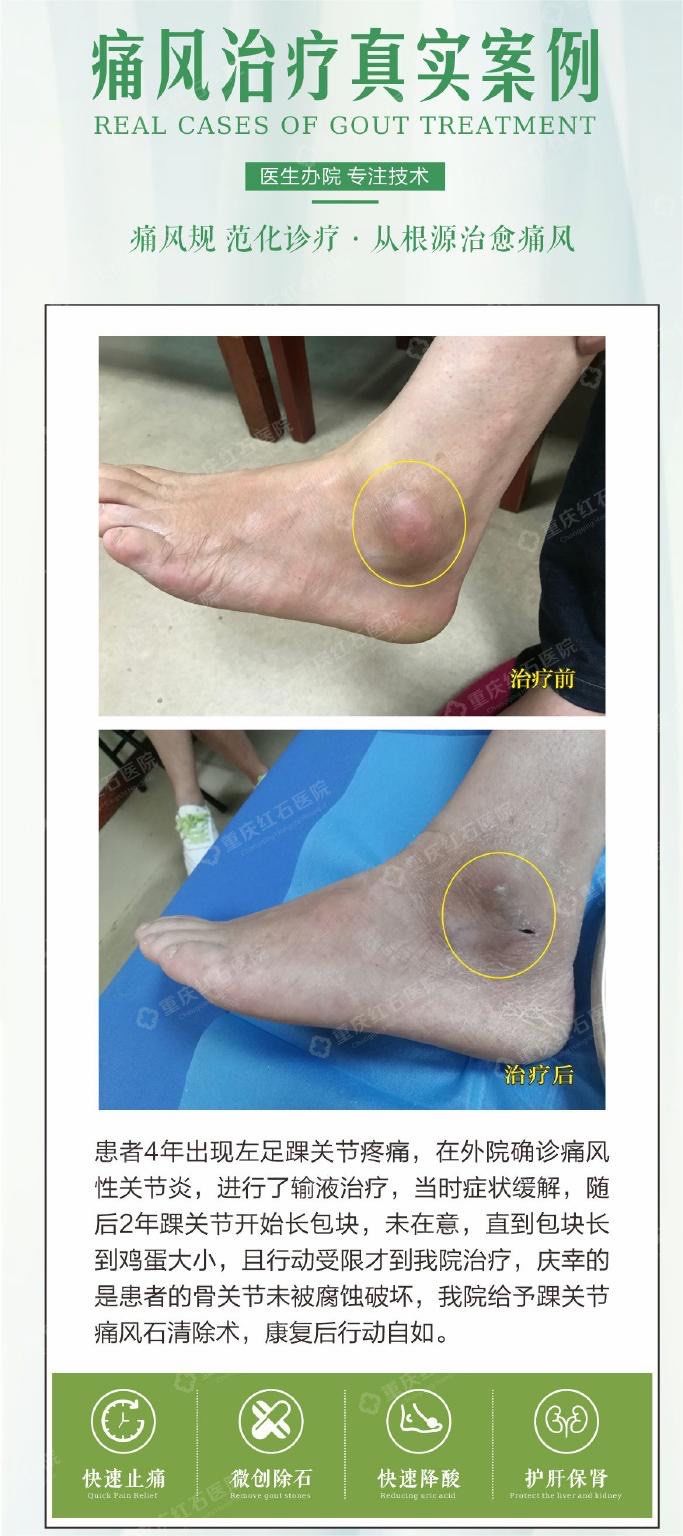 痛风医院重庆红石医院:微创高效治疗痛风石