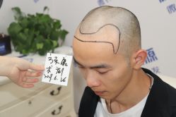 点击看大图 -大麦微针植发丨全国连锁