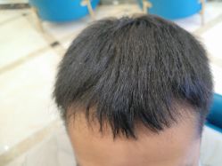 -碧莲盛·不剃发植发