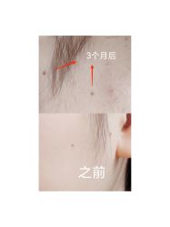 -痣缘宫