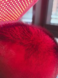 -碧莲盛·不剃发植发