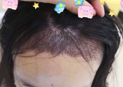 -大麦微针植发全国连锁