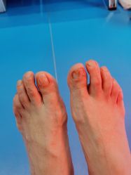 -足太医扦脚·灰指甲·嵌甲