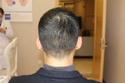 -大麦微针植发丨全国连锁