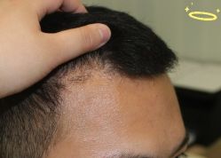 -大麦微针植发丨全国连锁