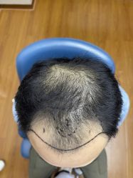 体验前-大麦微针植发全国连锁