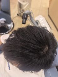 -大麦微针植发全国连锁