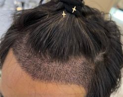 -大麦微针植发全国连锁