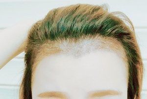 -大麦微针植发丨全国连锁