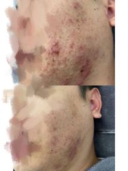 -瓷肌博士·祛痘科技美肤