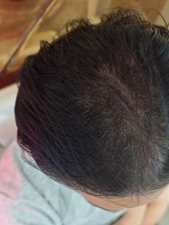 -碧莲盛·不剃发植发