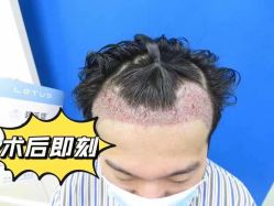 点击看大图 -碧莲盛·不剃发植发