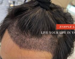 -大麦微针植发全国连锁