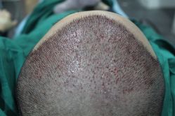 点击看大图 -大麦微针植发丨全国连锁