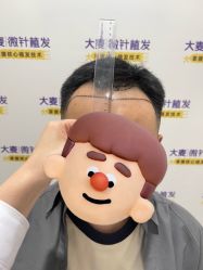 -大麦微针植发全国连锁