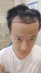 -大麦微针植发丨全国连锁