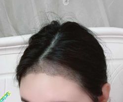 -大麦微针植发丨全国连锁