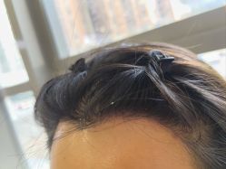 -碧莲盛·不剃发植发