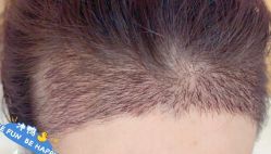 -大麦微针植发丨全国连锁