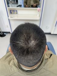 -大麦微针植发全国连锁