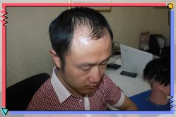 -大麦微针植发全国连锁