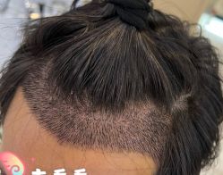 -大麦微针植发全国连锁