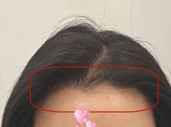 -大麦微针植发全国连锁
