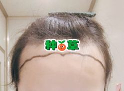 -大麦微针植发全国连锁