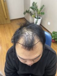 体验前-大麦微针植发全国连锁