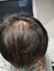 -碧莲盛·不剃发植发