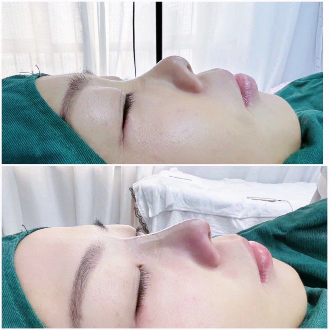 07 线雕鼻综合 完美侧颜
术前鼻部