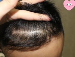 -大麦微针植发丨全国连锁