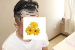 -大麦微针植发丨全国连锁