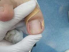 -Andrew指甲专科灰指甲·甲沟炎矫正·3D步态矫形鞋垫定制(浦三路店)