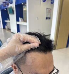 -大麦微针植发全国连锁