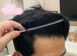 -大麦微针植发丨全国连锁