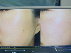 -苑苑vbeauty科技美容SPA