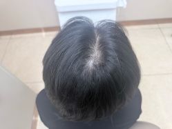 -大麦微针植发全国连锁
