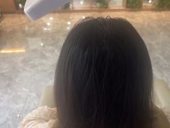 -碧莲盛·不剃发植发