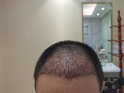 -碧莲盛·不剃发植发