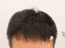 -大麦微针植发全国连锁