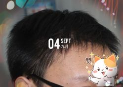 -大麦微针植发全国连锁