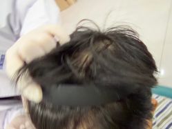 -碧莲盛不剃发植发