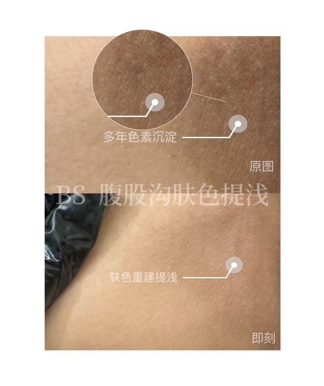 腹股沟提浅