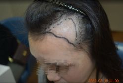 体验前-大麦微针植发全国连锁